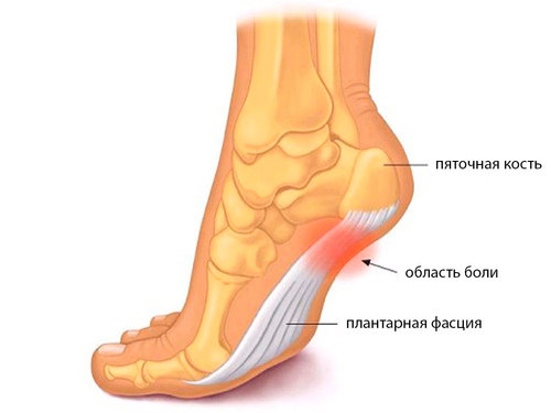 plantarnyj-fasciit.jpg