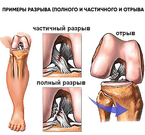 Разрыв-связок-коленного-сустава.jpg